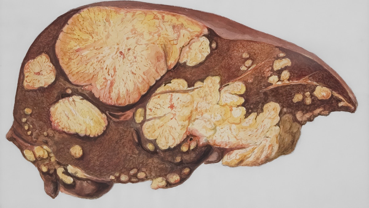 Az ifjúsági cukorbetegség titkai
